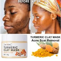 Turmeric & Vitamin C Clay Mask - Acne Treatment, Dark Spot Corrector, Exfoliating & Deep Cleansing